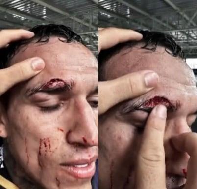 A look at Charles Oliveira’s cut that forced him out of his rematch against Islam Makhachev.