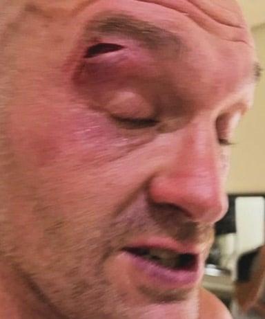 Photo of the Tyson Fury cut that forced him out of the Usyk fight