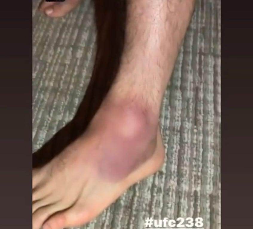 Henry's ankle 4 days before fighting Marlon Moraes